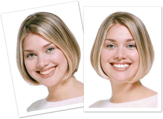 Before & After Teeth Whitening - competition time