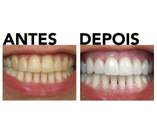 Kit de clareamento dos dentes antes e depois da foto de revisão