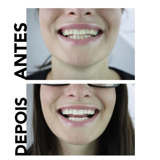 dentes naturais branqueamento creme dental antes e depois